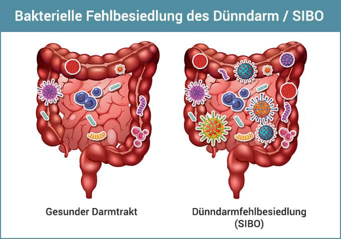 How to recognize SIBO symptoms